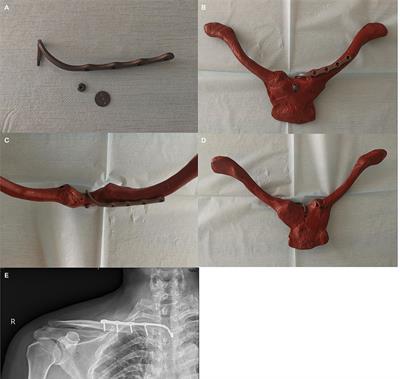 A Sternoclavicular Joint-Specific Plate for the Displaced Medial-End Clavicle Fracture